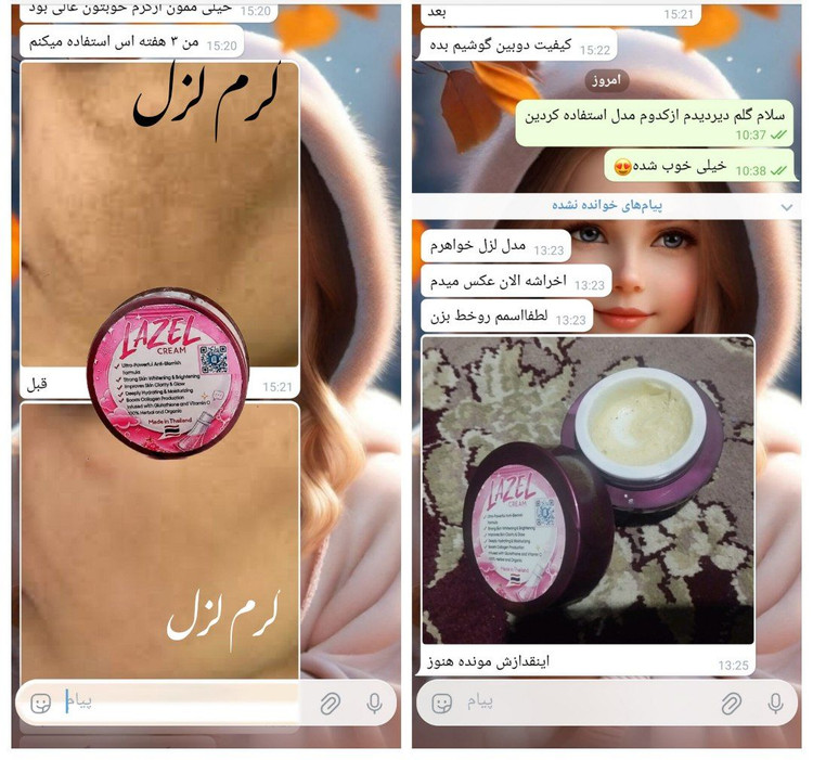 اعلام رضایت هموطن #عزیزمون ازکرم لزل اورجینال😍👌🏻 ایشون فقط۳ هفته ازکرم لزل #استفاده کردندلکهاے پوستشون خیلی بهترشده ۸۰ درصدلکهادرمان شدند ✔️✔️✔️ پوستشون #چنددرجه روشن تروشفاف ترشده دوره درمان ادامه دارد🥰
